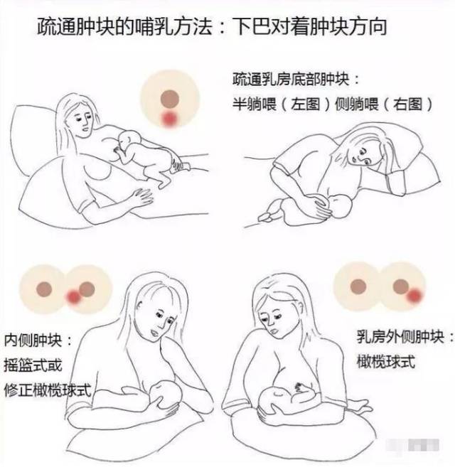 產(chǎn)后漲奶，疼痛難忍怎么辦？